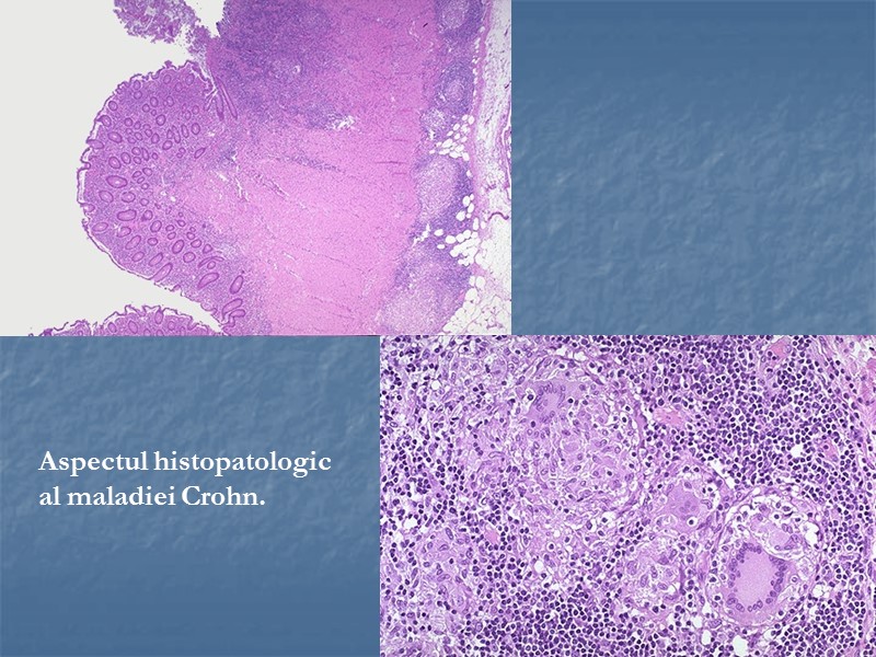 Aspectul histopatologic al maladiei Crohn.